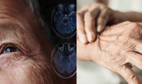 Could Parkinson’s Begin Years Before Symptoms Appear?