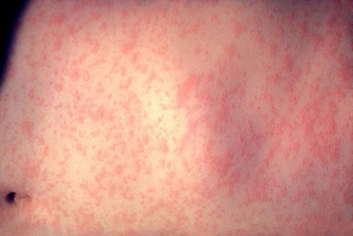 Dozens of children infected as measles spreads in London Dozens of children infected as measles spreads in London