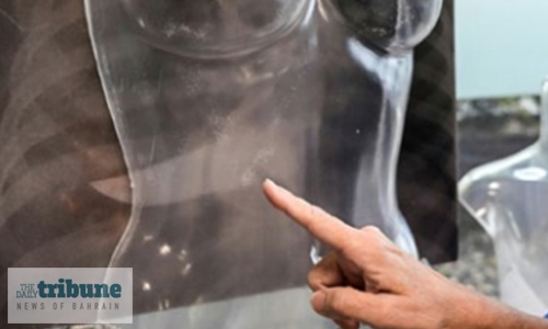 X-rays of broken bones lay bare domestic violence in Italy