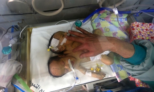 Yemeni conjoined twins die in Sanaa Yemeni conjoined twins die in Sanaa