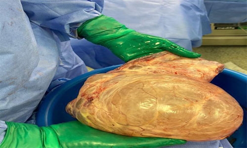 Tumour weighing 6 kg removed from woman's uterus at King Hamad University Hospital