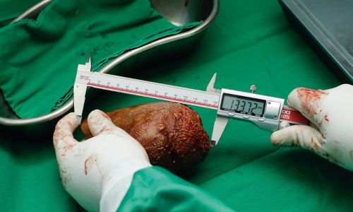 Sri Lankan doctors remove ‘world’s largest kidney stone’ 