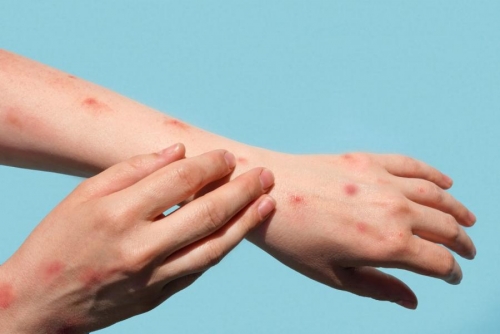 Covid control recipe ‘applies to Monkeypox too’ 