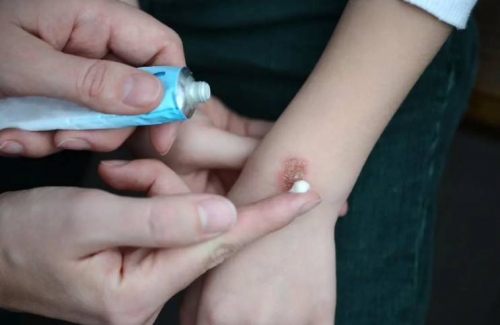 Alert call against using toothpaste to treat burn injuries